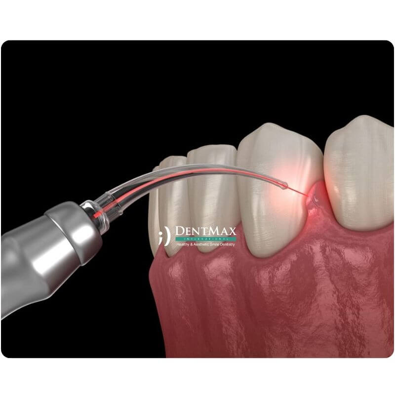 Dentmax
