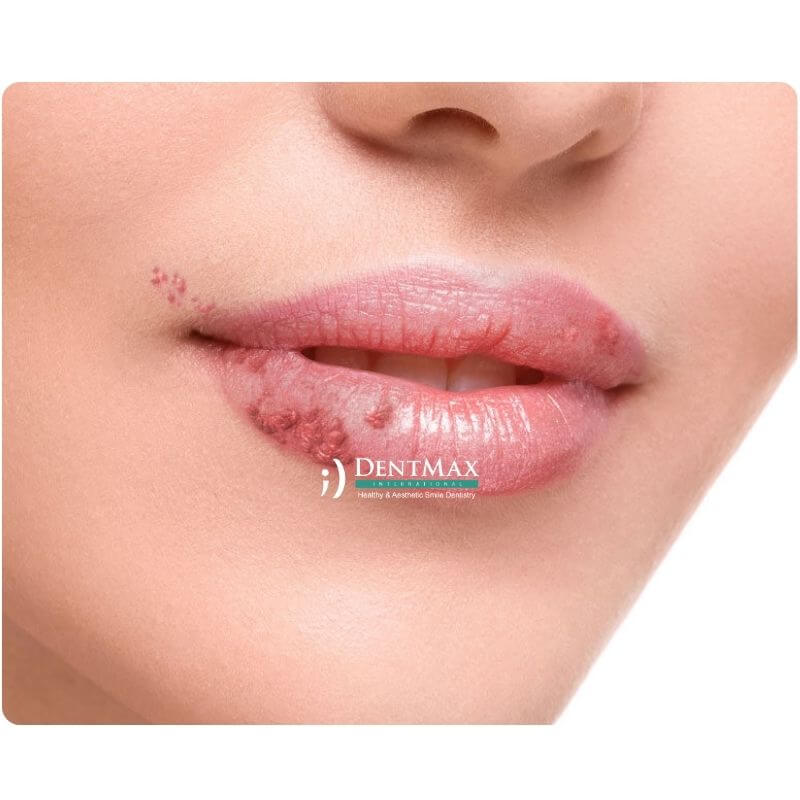 Dentmax