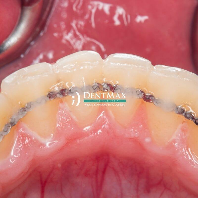 Dentmax