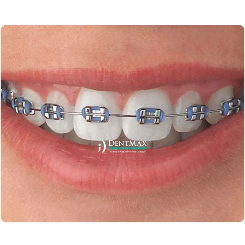 Dentmax