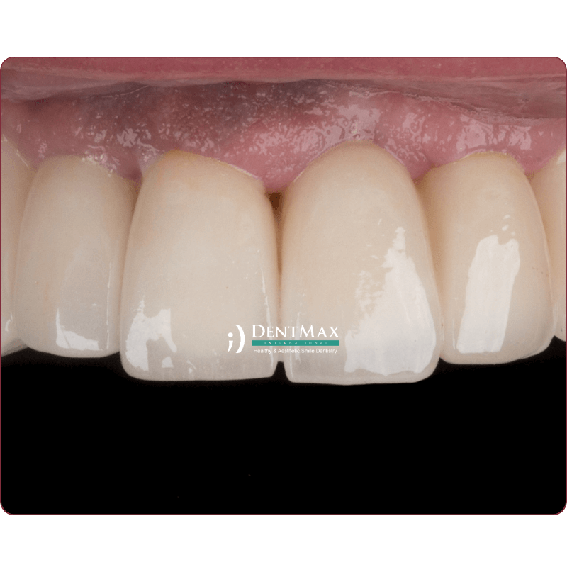 Dentmax