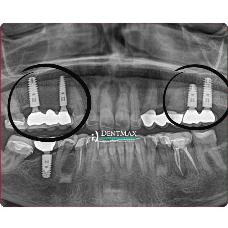 Dentmax