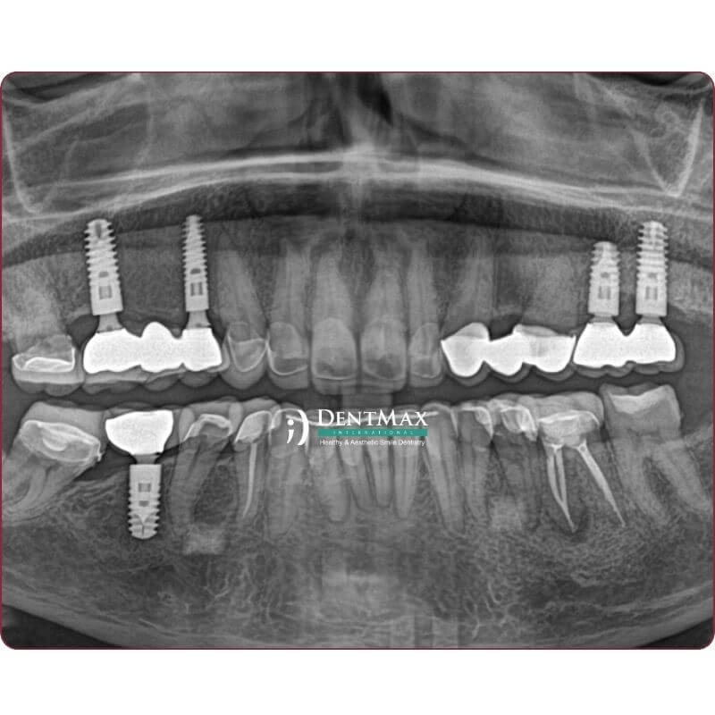 Dentmax