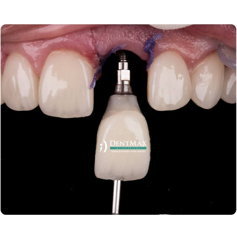 Dentmax