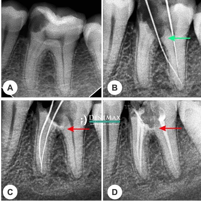 Dentmax