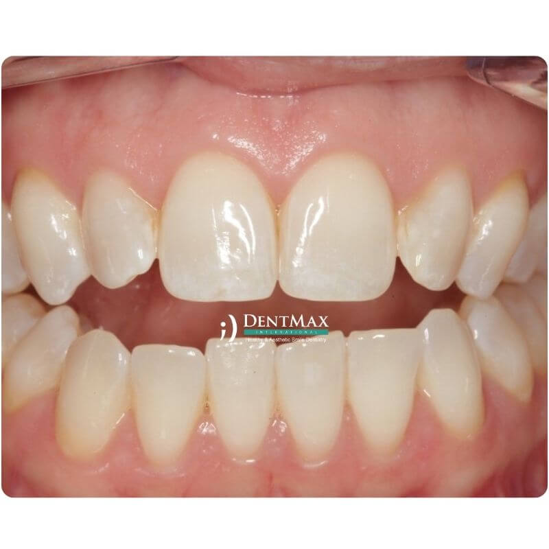 Dentmax