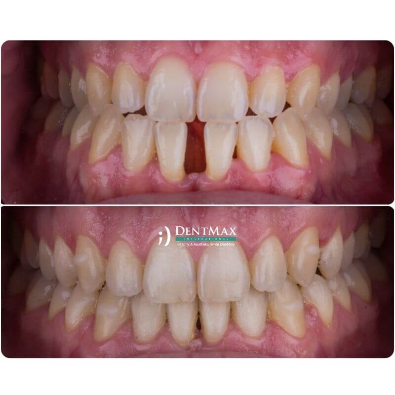 Dentmax