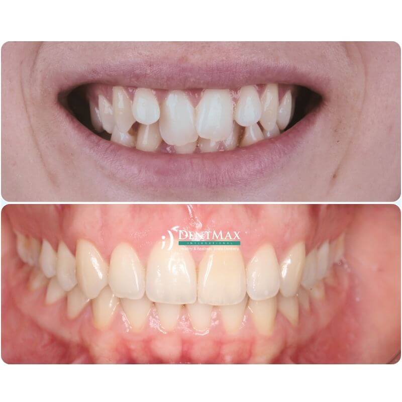 Dentmax