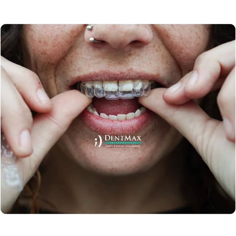 Dentmax