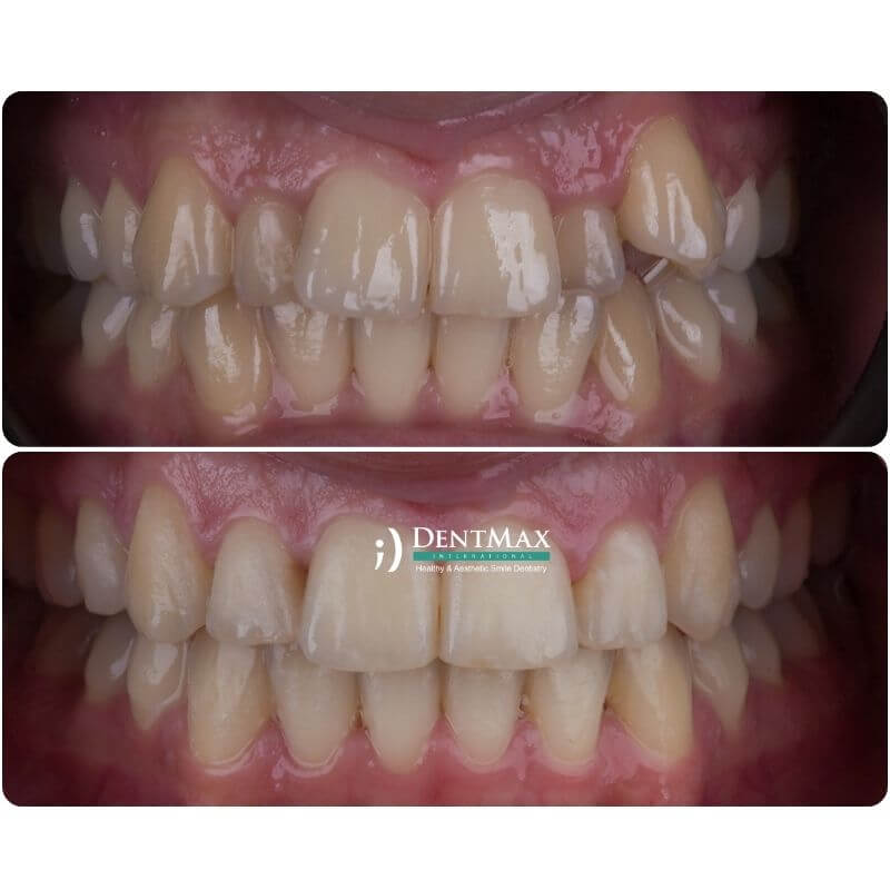 Dentmax
