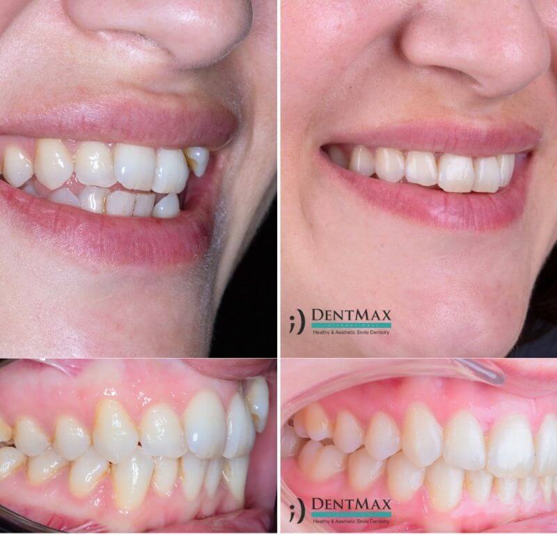 Dentmax