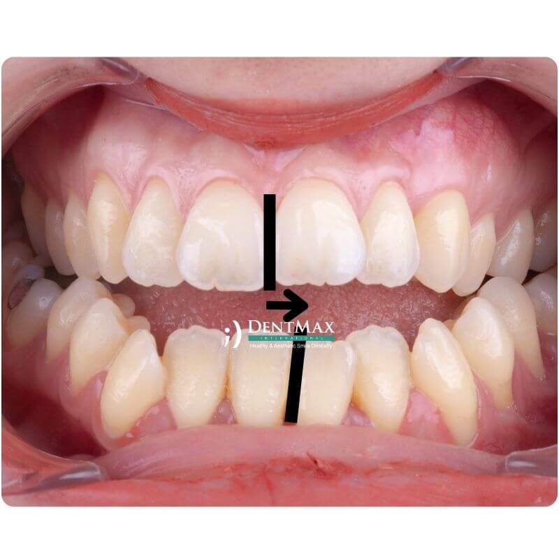 Dentmax