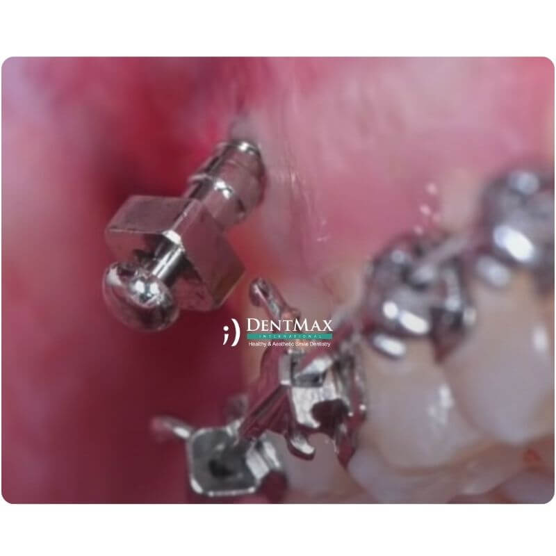 Dentmax