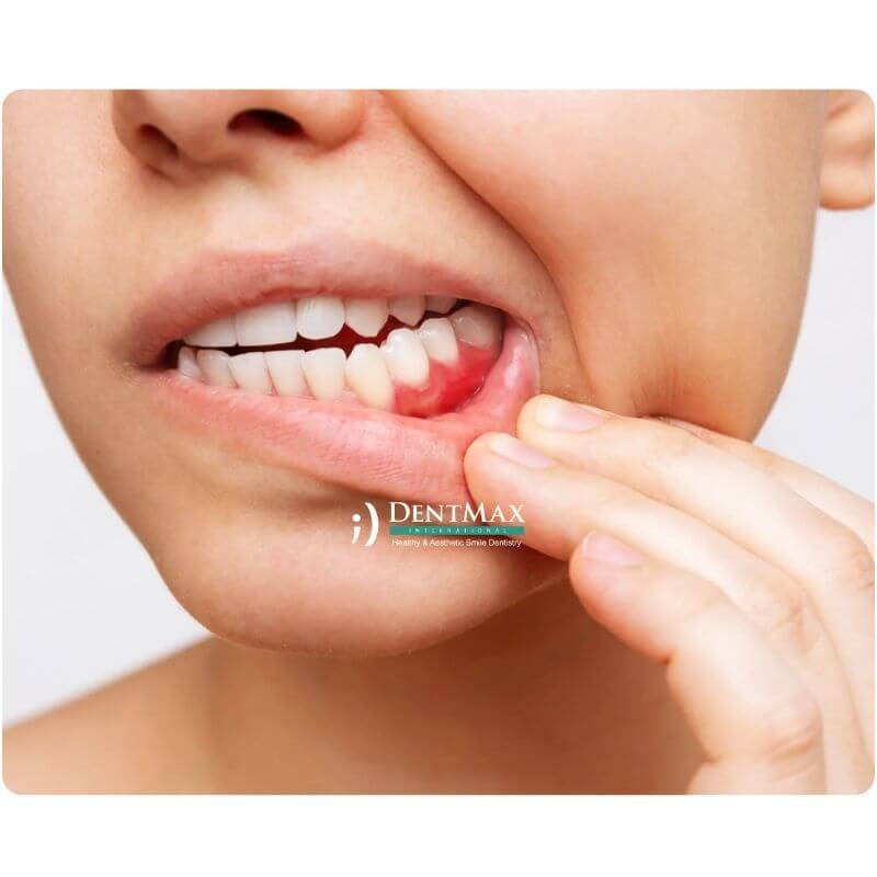 Dentmax