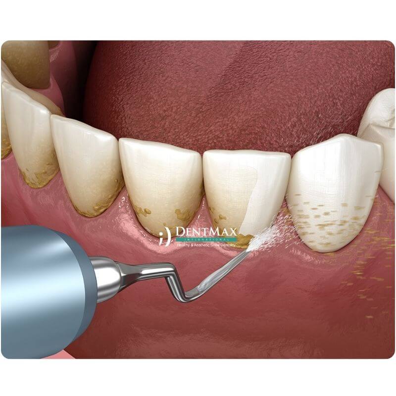 Dentmax