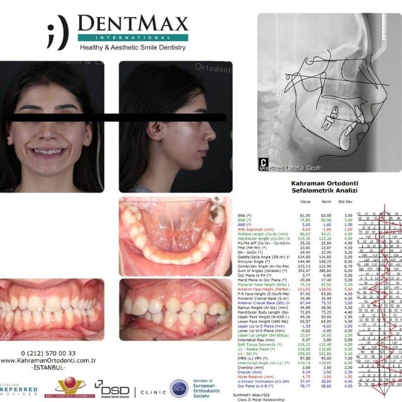 Dentmax