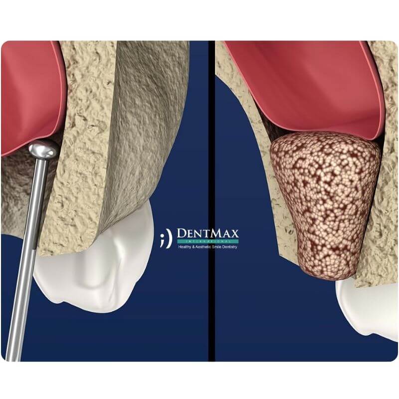 Dentmax