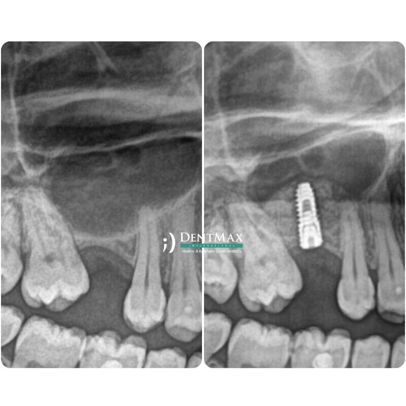 Dentmax