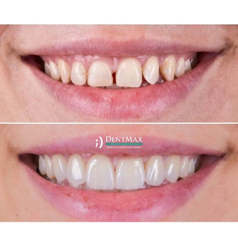 Dentmax