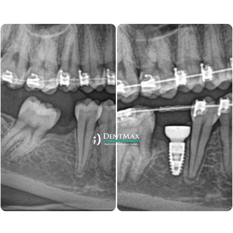 Dentmax