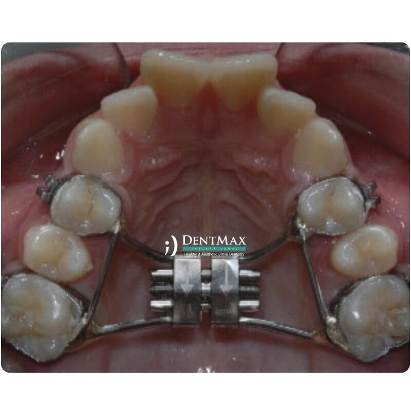 Dentmax