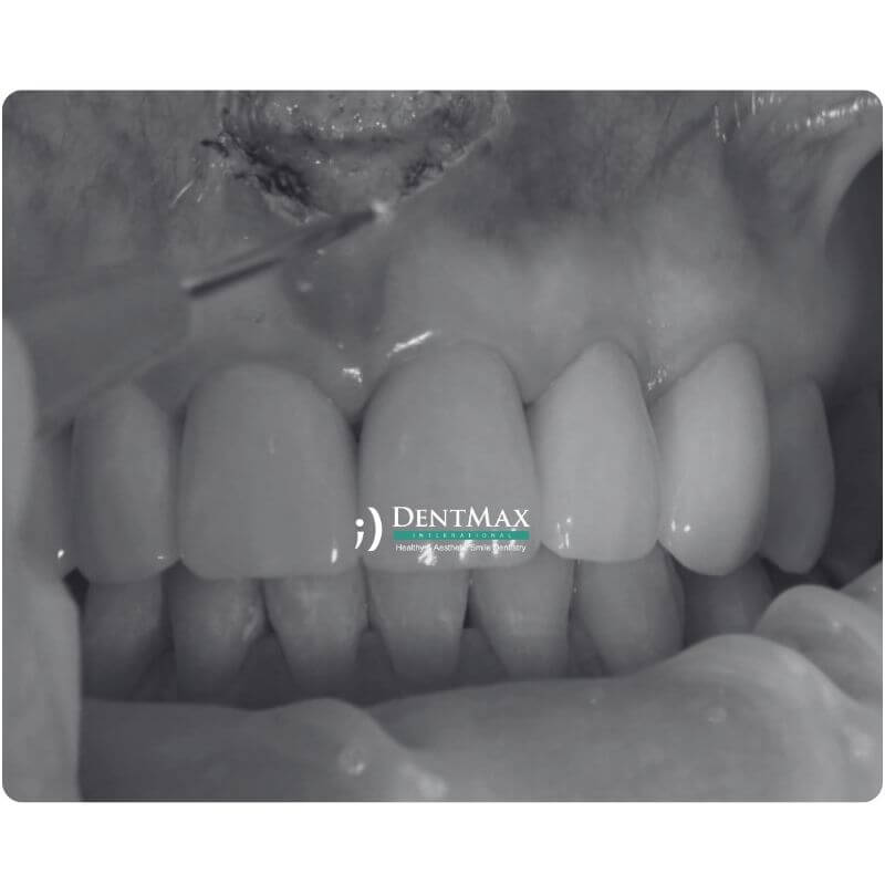 Dentmax
