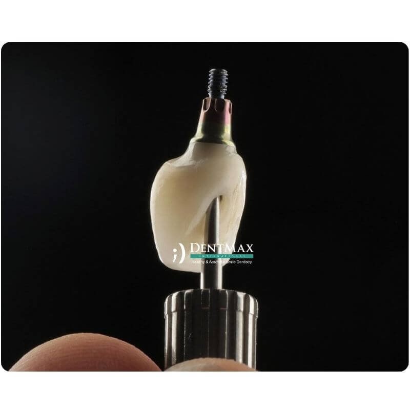 Dentmax