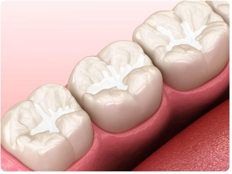 Dentmax