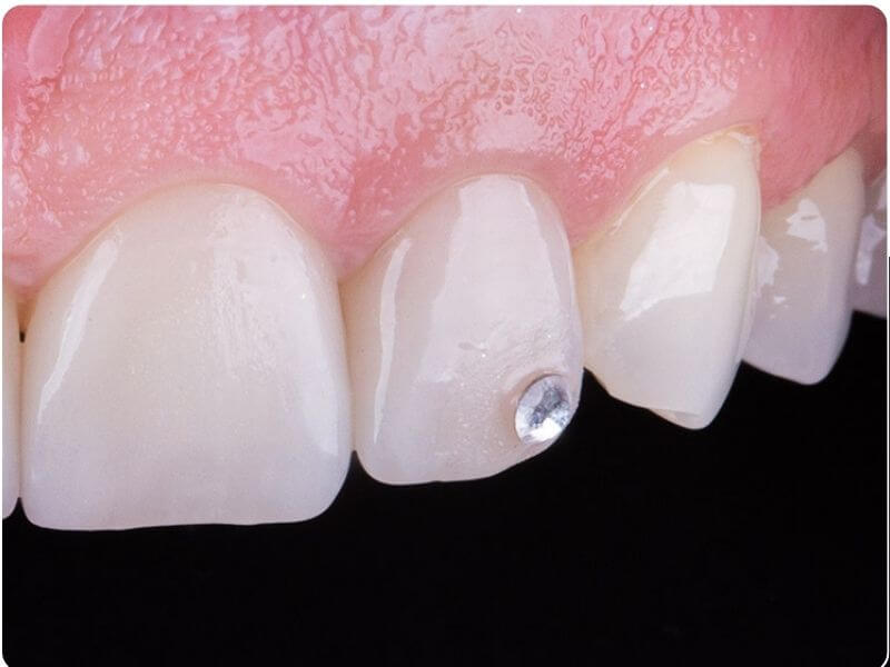 Dentmax