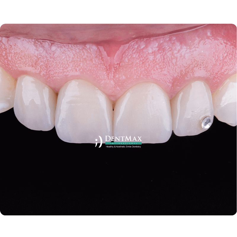 Dentmax
