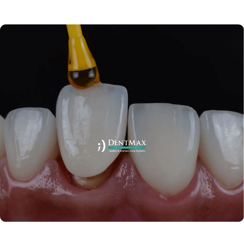 Dentmax