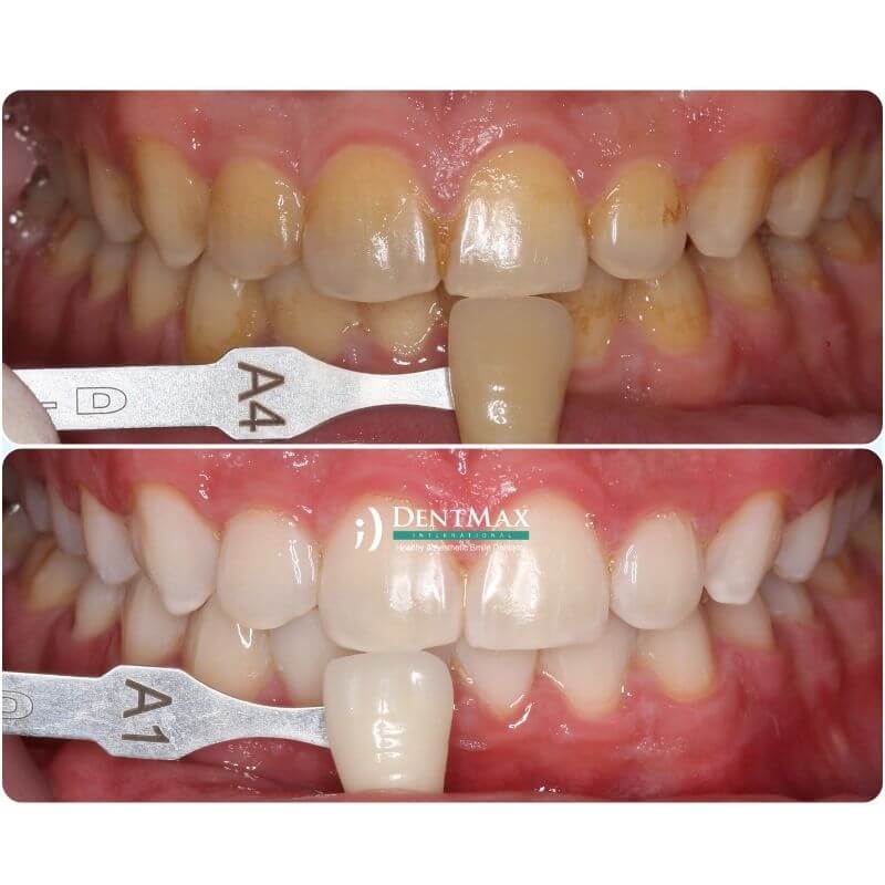 Dentmax