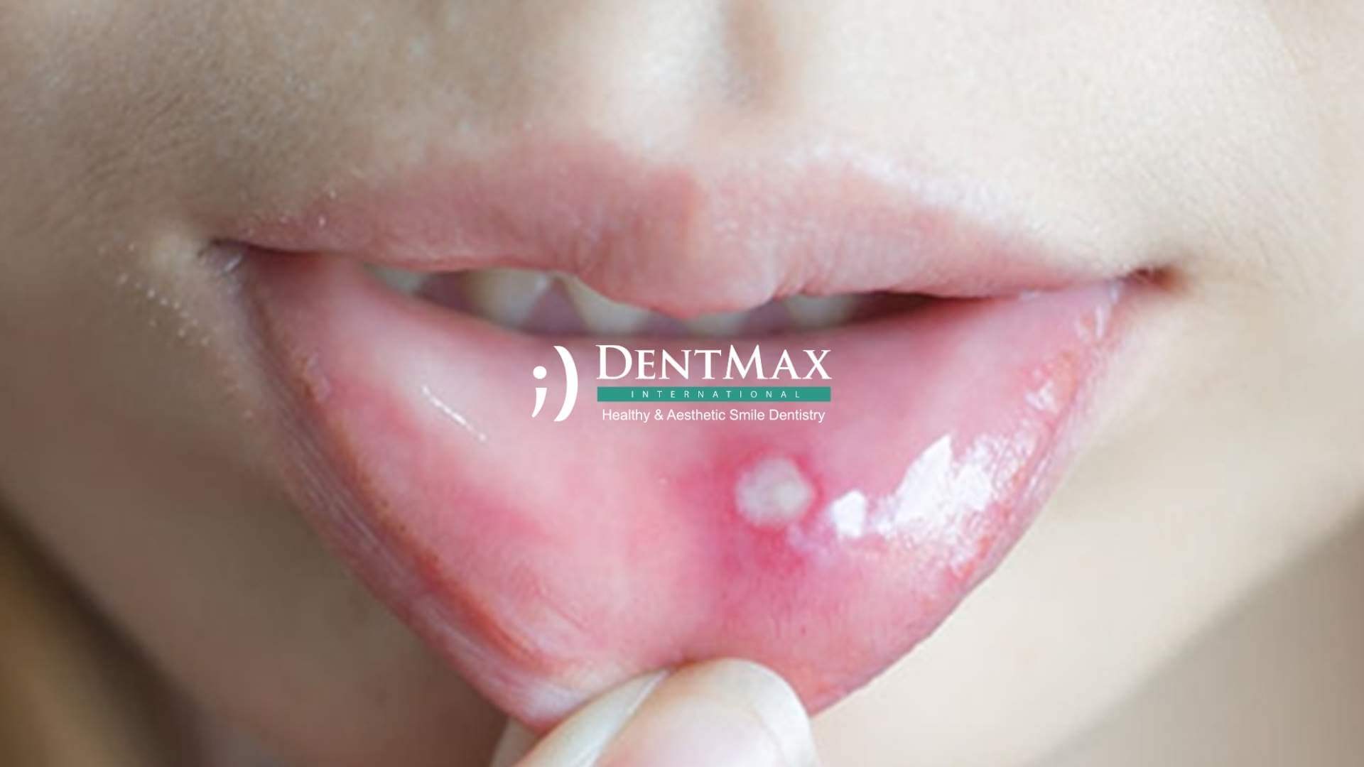 Dentmax Basından