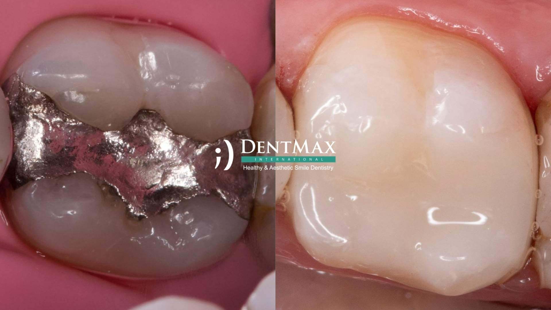 Dentmax Basından