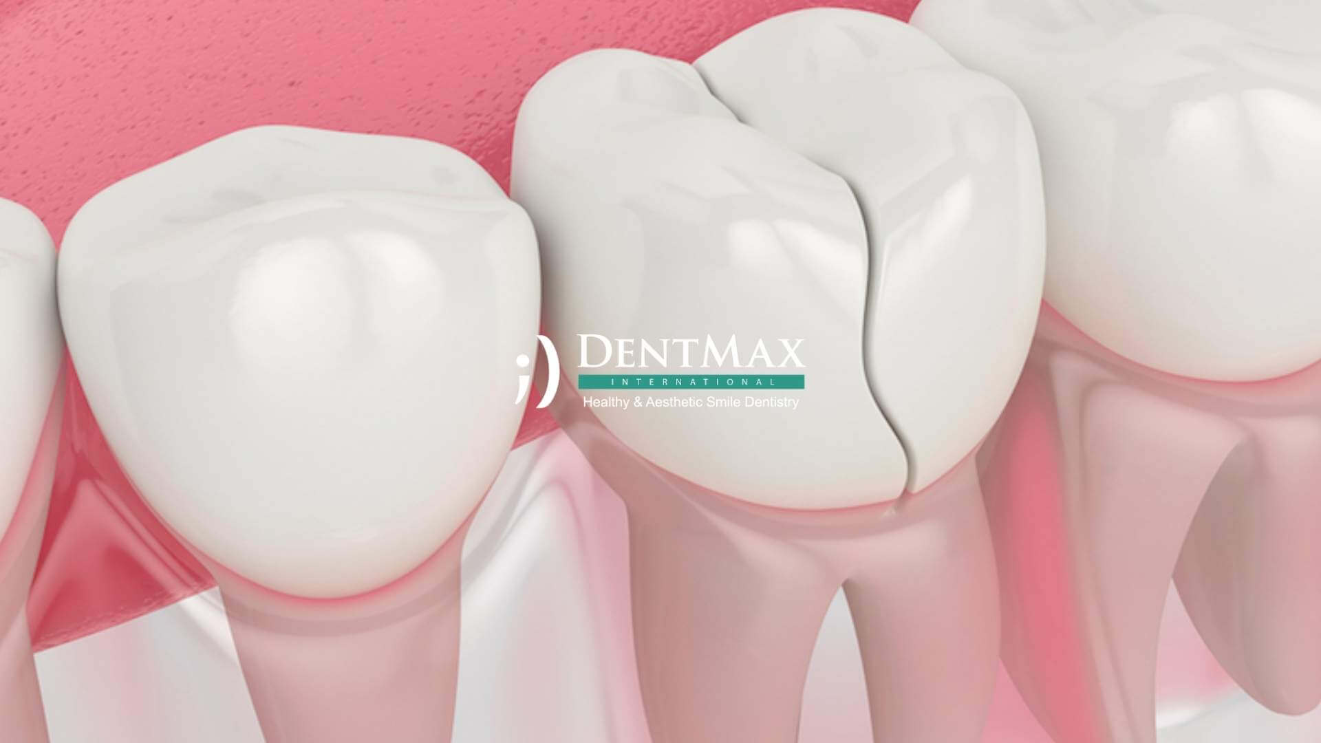 Dentmax Basından