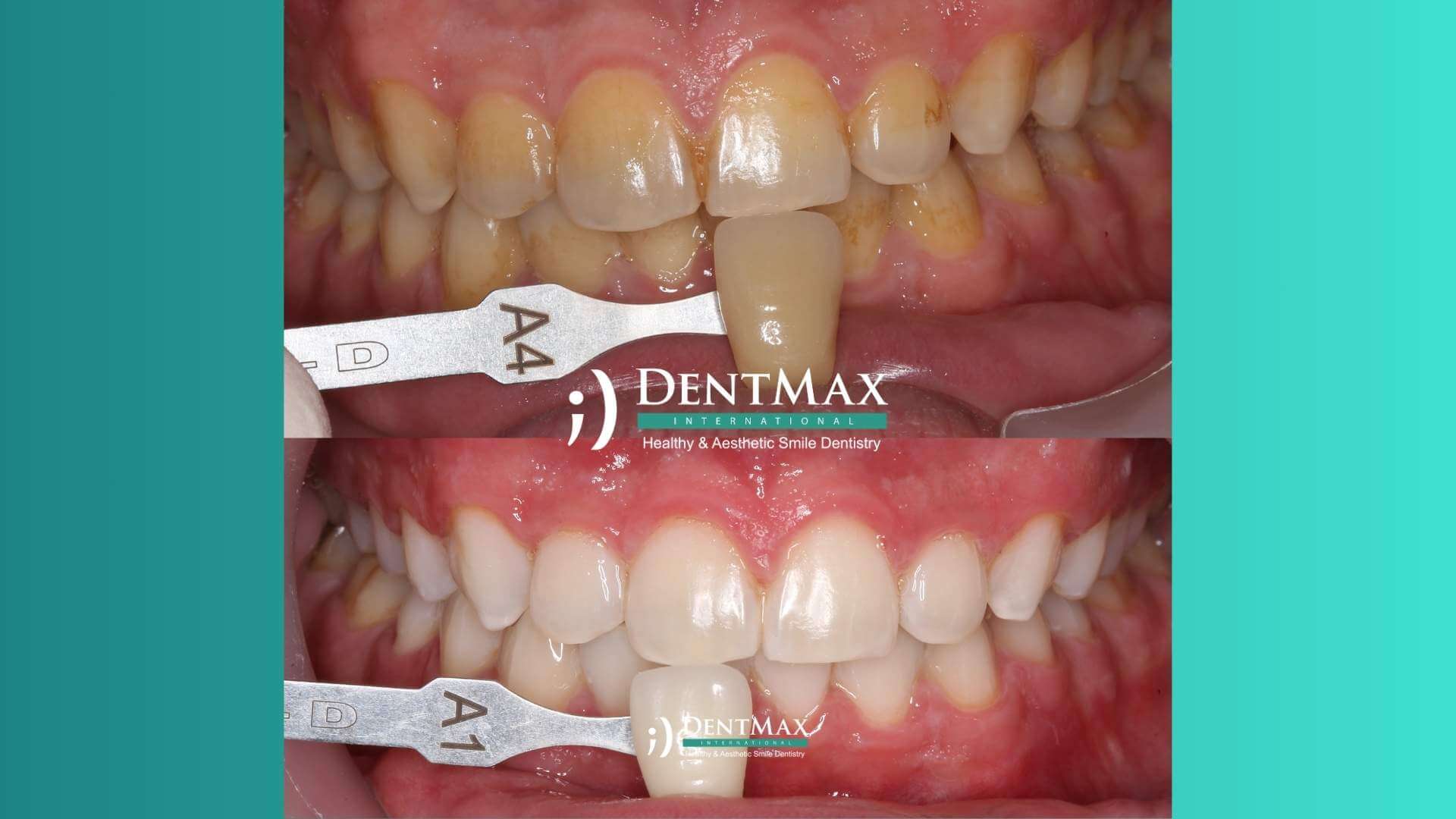 Dentmax Basından