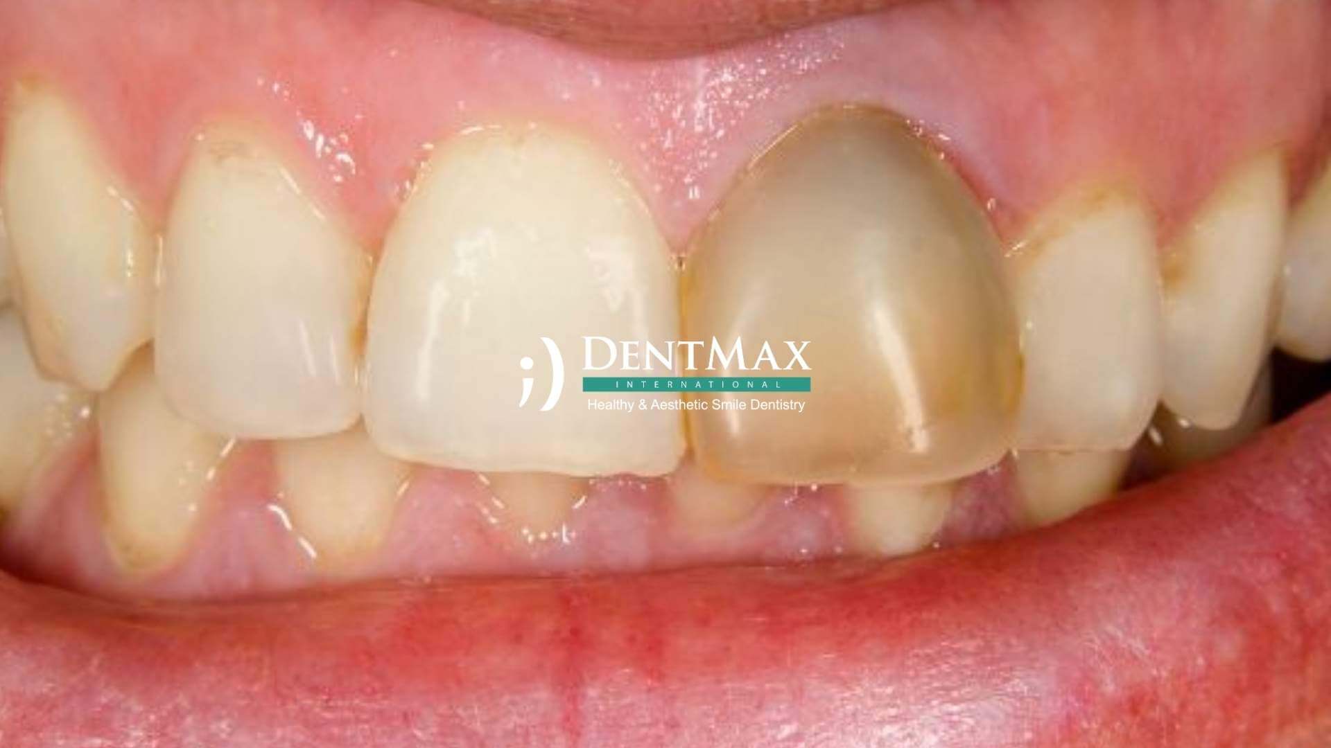Dentmax Basından