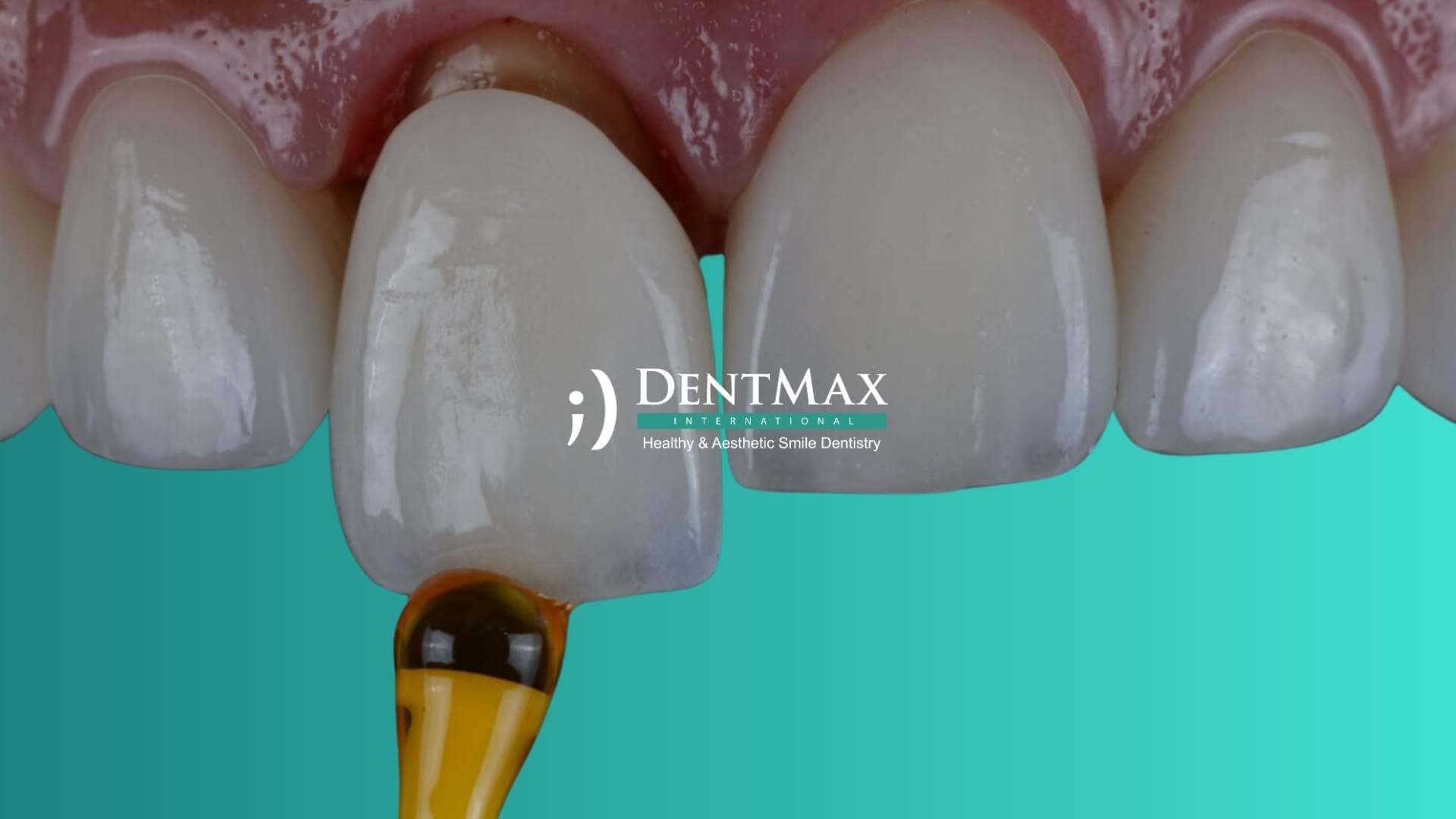 Dentmax Basından