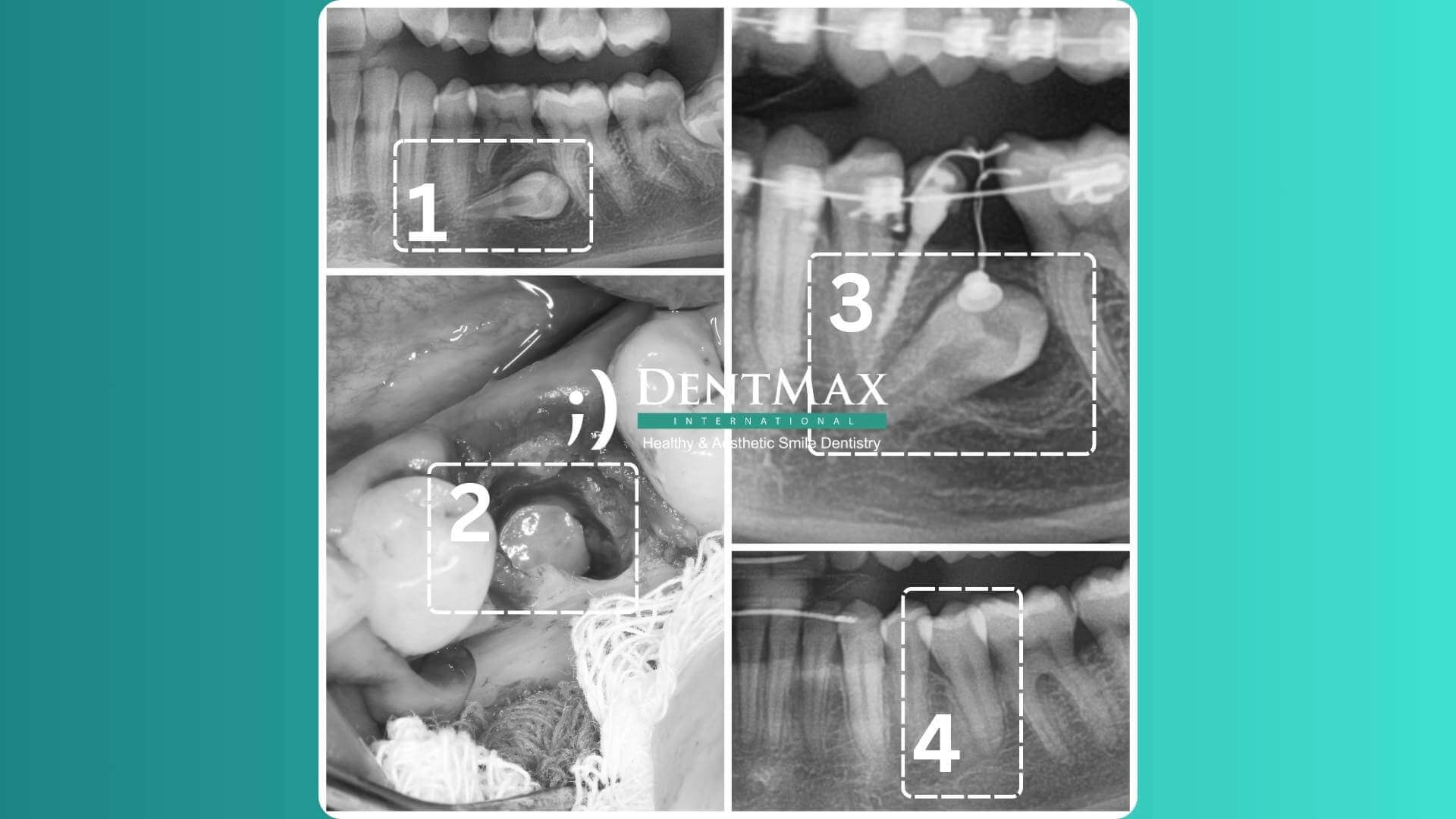 Dentmax Basından