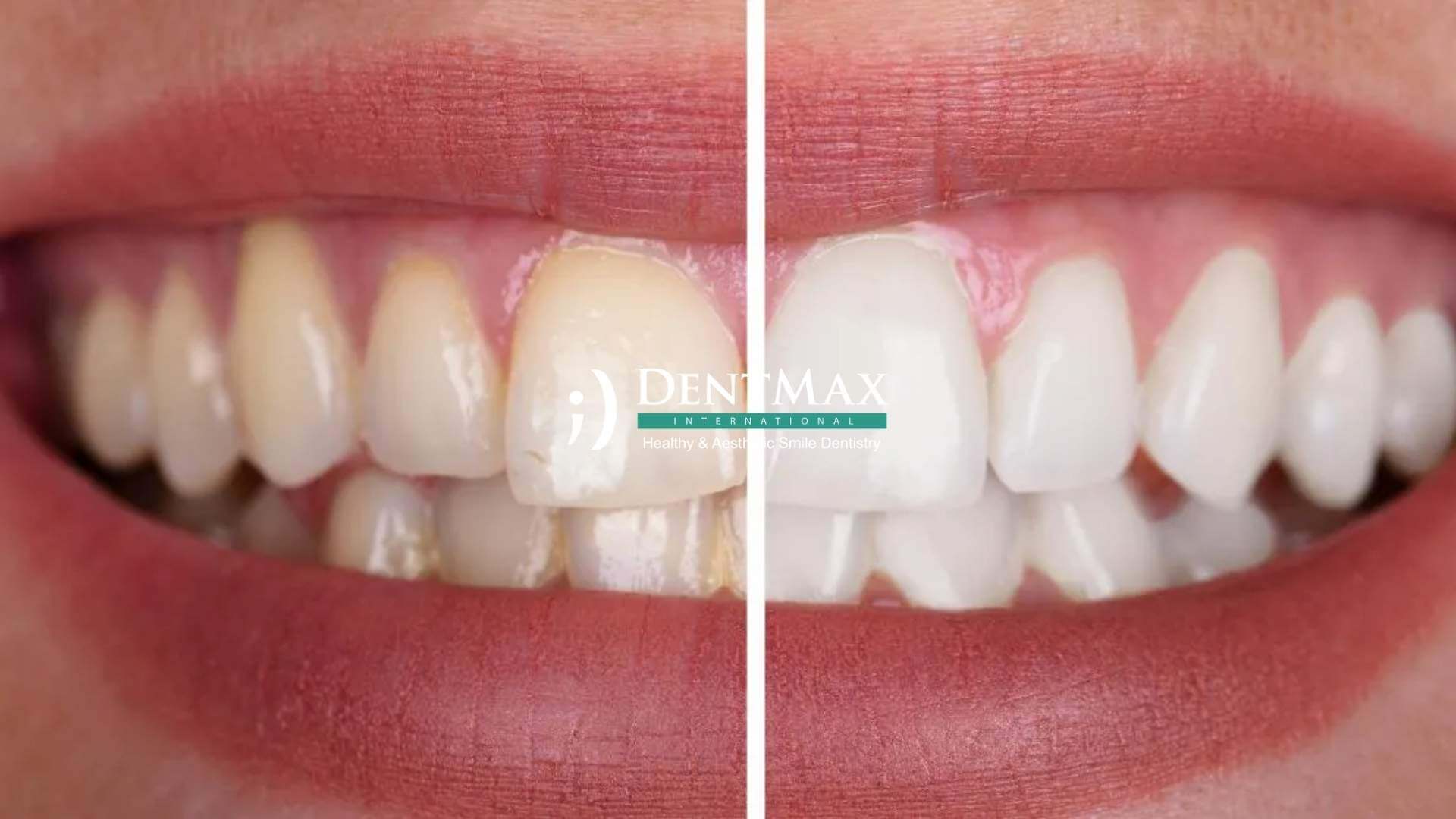 Dentmax Basından