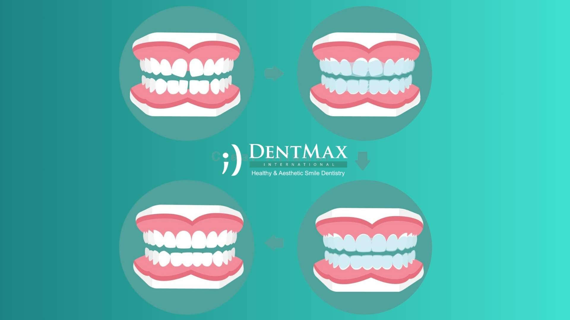 Dentmax Basından