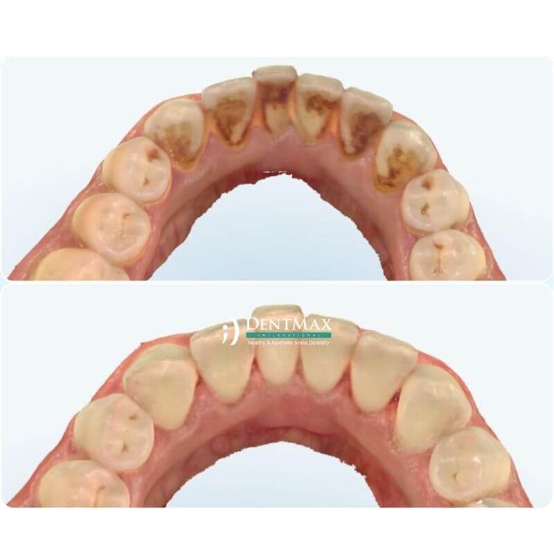 Dentmax