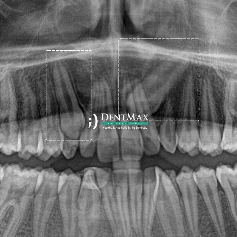 Dentmax Öne Çıkanlar