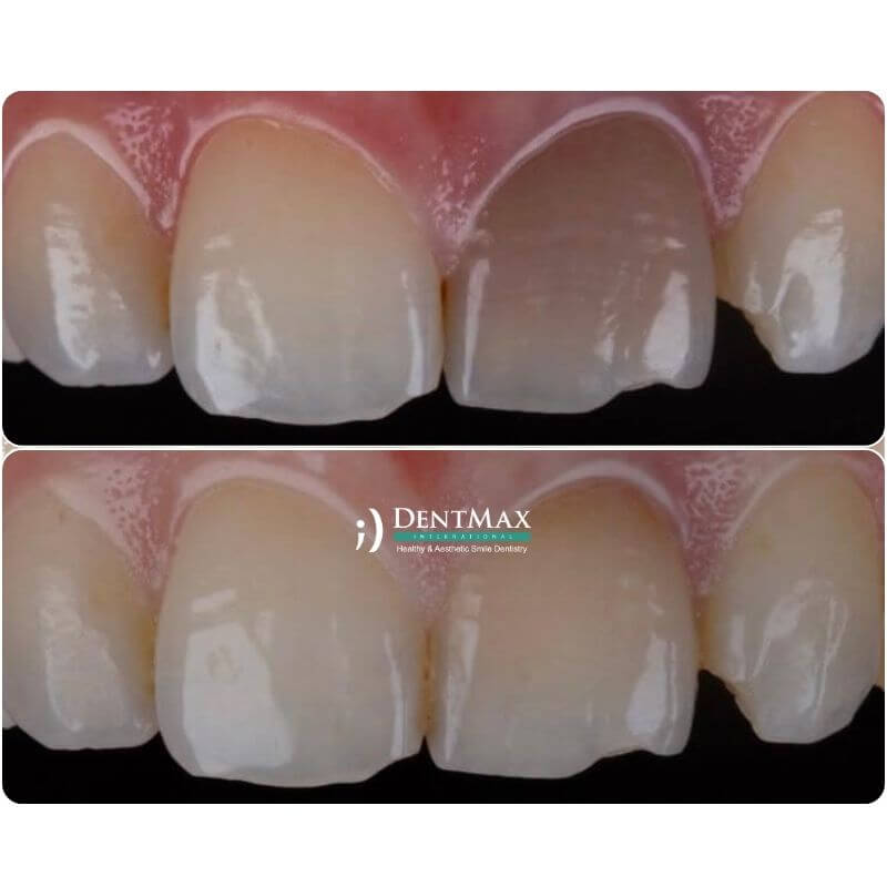 Dentmax