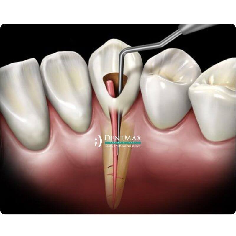 Dentmax Öne Çıkanlar