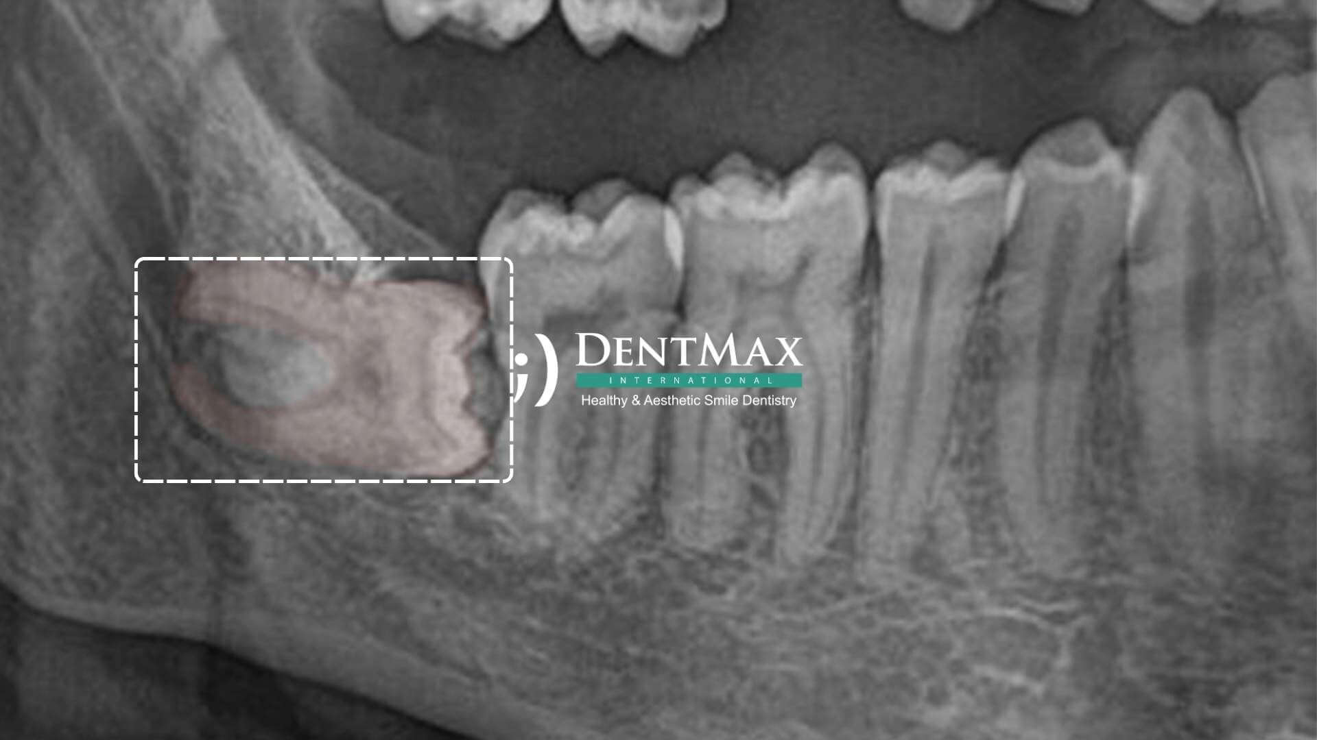 Dentmax Tedaviler