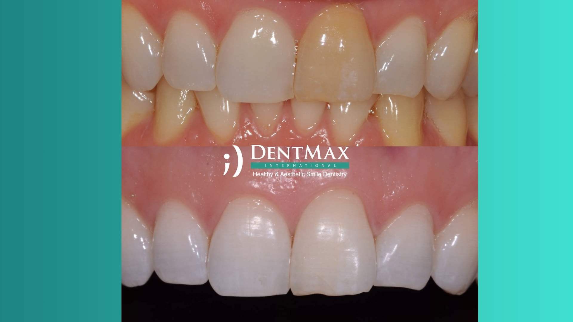 Dentmax Tedaviler