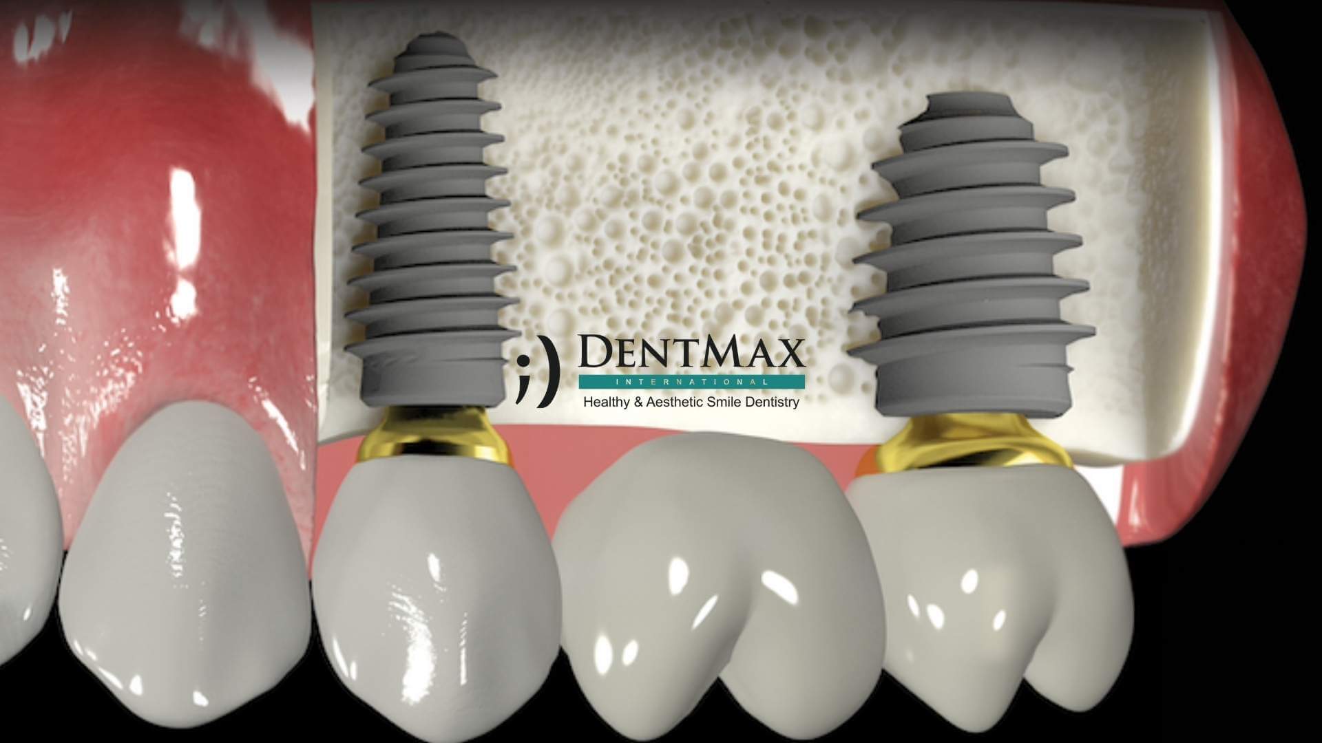 Dentmax Tedaviler