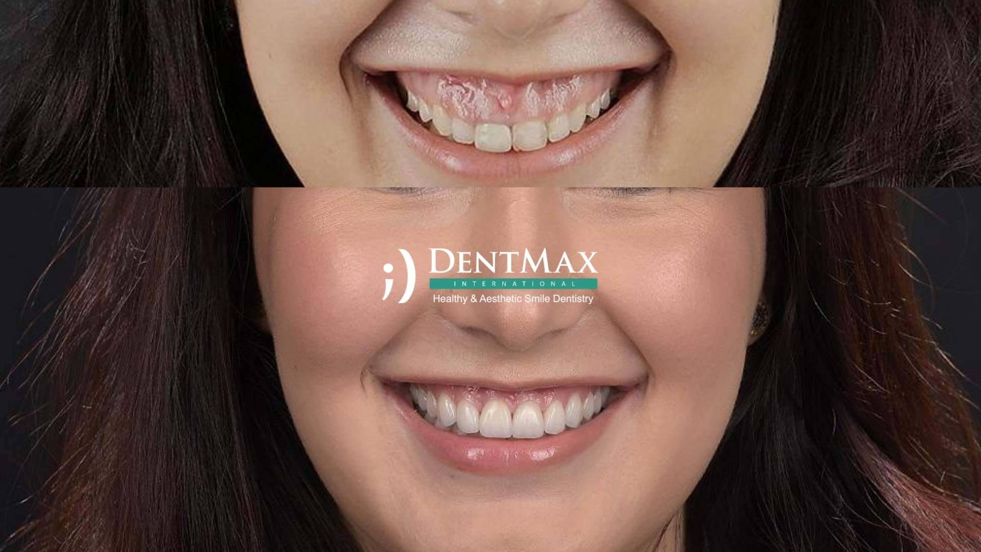 Dentmax Tedaviler
