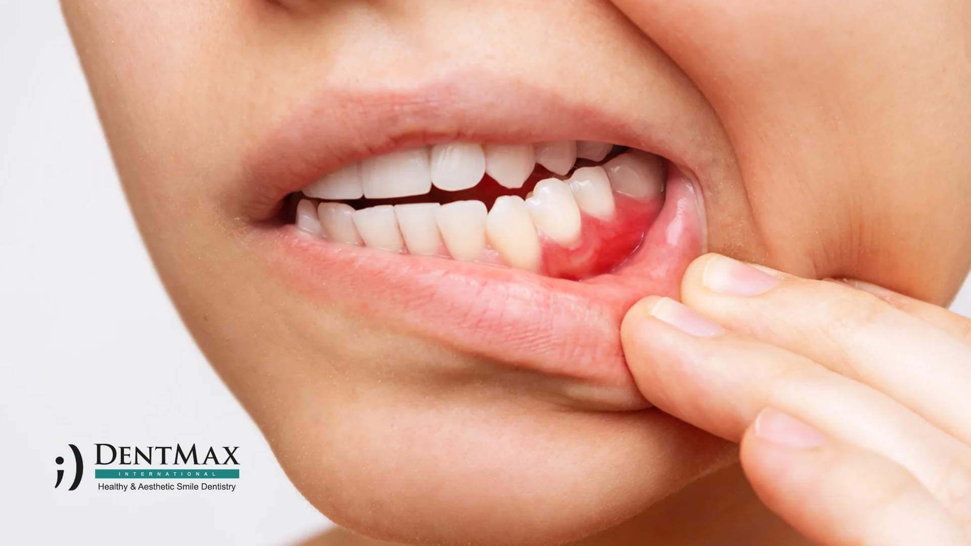 Dentmax Tedaviler